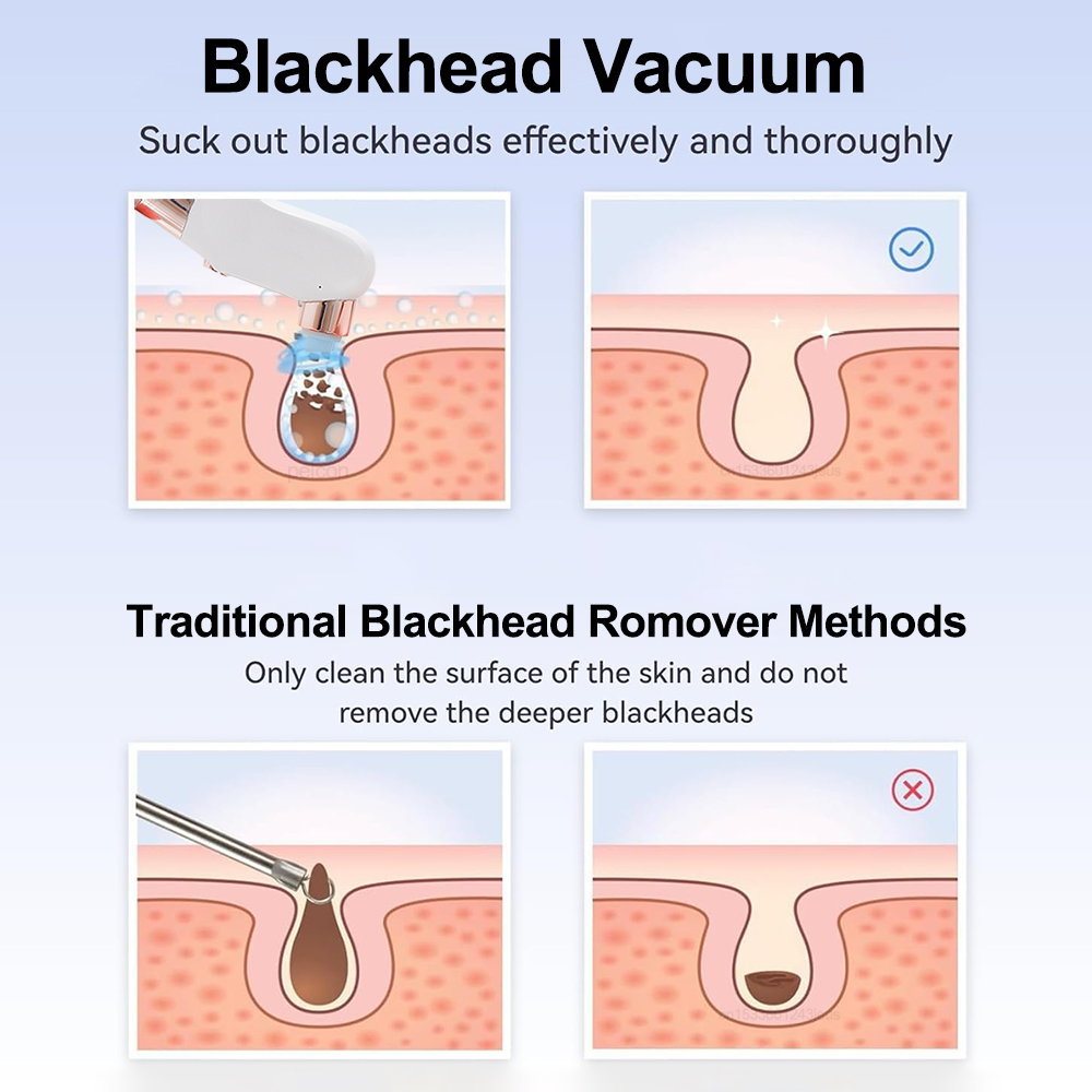 ไฟฟ้า สิวหัวดํา Remover สูญญาก - Pore Vacuum บทวิจารณ์และราคา